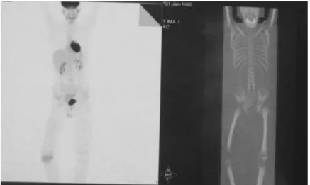 Fig. 4. Three-phase scintigraphy images of the right end of proximal tibia showing increased activity in the late-term