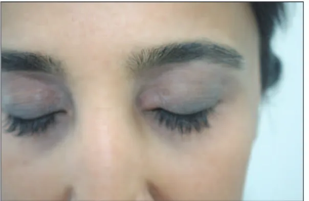 FIGURE 2: An erythematosus asymptomatic nodular lesion of 0.5 cm on the medial cantus of the patient’s right upper eyelid.