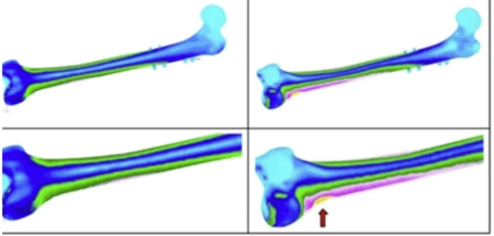 Fig. 6. Displacement was observed at the fracture site at simulation model of the fall.