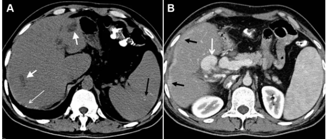 Fig. 1 e Noncontrast CT image demonstrates (A) caudate lobe hypertrophy (long arrows), intrahepatic bile duct dilatation (short white arrows), millimetric calcification in the liver capsule (open arrow), and siderotic nodules in the spleen
