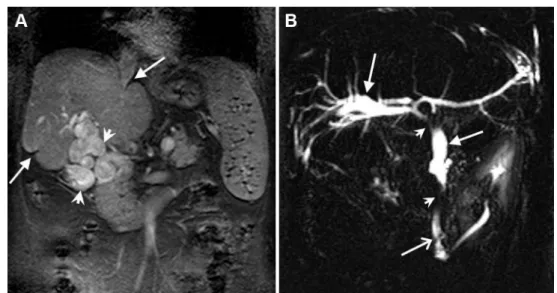 Fig. 3 e Coronal, fat-saturated contrast-enhanced T1-weighted MR image (A) demonstrates lobulated hepatic contour and parenchymal retraction due to fibrous septas (arrows) and retractions