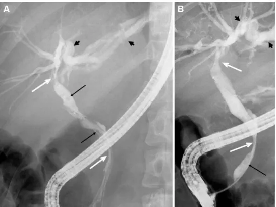 Fig. 4 e Endoscopic retrograde cholangiopancreatogram images (A, B) demonstrate common bile duct stenosis at the bifurcation level and the distal segment (white arrows), dilatation of intrahepatic and extrahepatic bile ducts (arrow heads), and millimetric 
