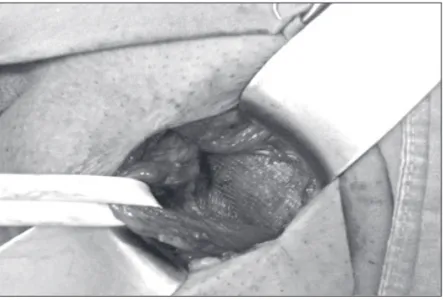 Figure 2 – Operative insertion of ProGrip self adhesive mesh.