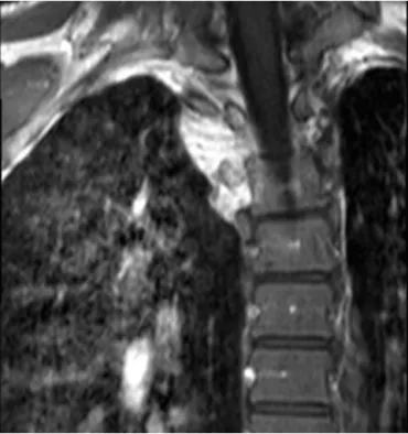 Fig. 3. microscopy of nerve sheath myxoma, red arrow indicate the tumoral tissue, white arrow indicates the peripheral nerve.
