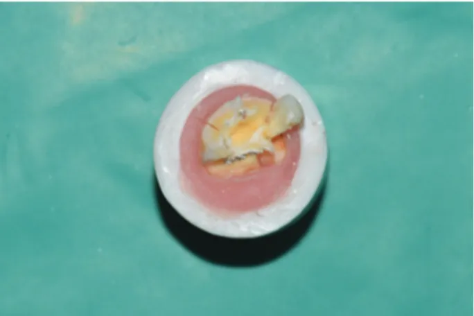 Figure 1 - A photography of a tooth that appears to be a  repairable fracture.
