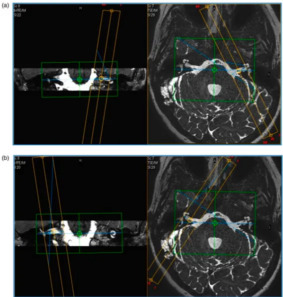 Figure 3 Parasagittal direct images set out on the axial images and coronal localizer images.