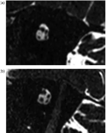Figure 4 Direct parasagittal heavily T2-weighted images. (A) Right hypoplastic cochlear branch