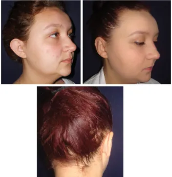 Fig. 3 A 20-year-old woman referred with bilateral prominent ears (left). A laterally based postauricular dermal flap was used as an addition to the Mustarde and Furnas sutures