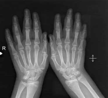 Fig. 2. X-ray showing a drumstick appearance.