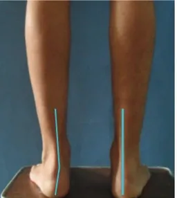Figure 4: Clinical images showing differences in opposite extremi- extremi-ties due to weight-bearing.
