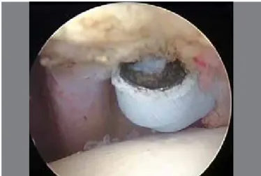 Figure 1. Release of rotator interval in left shoulder. Scope was inserted from  posterior portal and radiofrequency probe was inserted in anterior portal.