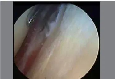 Figure 2. Release of posterior capsule in right shoulder. Scope was inserted  from posterior portal and arthroscopic scissor was inserted in anterior portal.