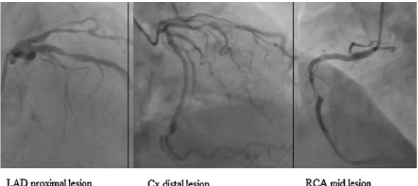Fig. 1 – Coronary angiographic images of the patient.