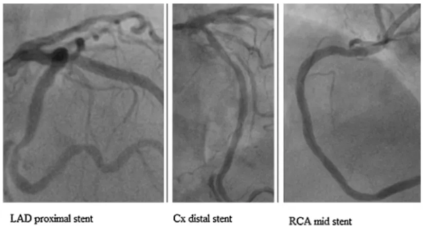 Fig. 2 – Coronary angiographic images of the patient after revascularization.