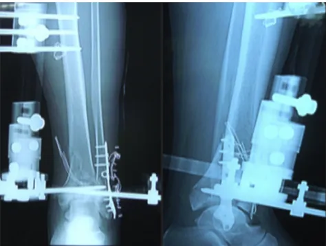 Fig. 2. Control roentgenograms on the ﬁrst post-operative day.
