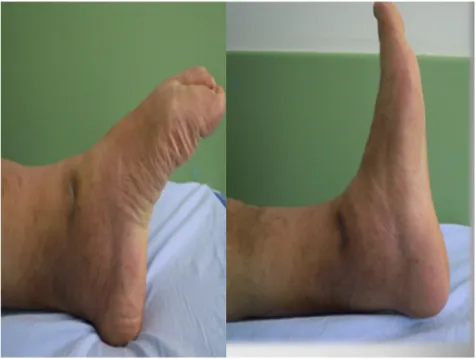 Fig. 4. Ankle range of motion 12 months after the operation.