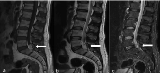 Figure 3. T1 (a) and T2 (b) sequences in sagittal plane,  T2 (c) and fat-sat T1 (d) sequences in axial plane  shows no hematoma at L5-S1 level.