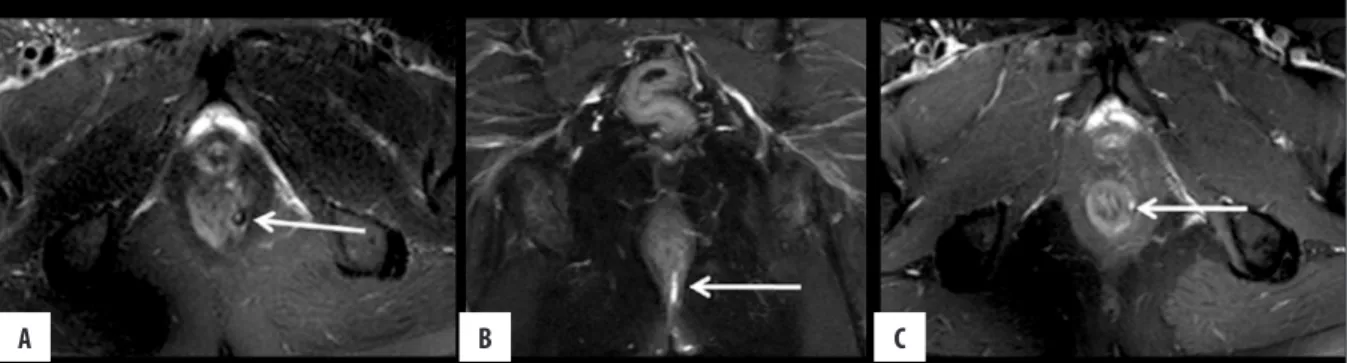 Figure 2.  Grade 1 perianal fistula; linear  intersphincteric. Axial (A) and coronal  (B) contrast-enhanced fat-suppressed  T1-weighted MR images show contrast  enhancement of the left posterolateral  intersphincteric fistula (arrows)  surrounded by the ex
