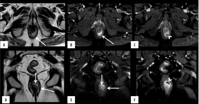 Figure 3.  Grade 2 perianal fistula; intersphincteric fistula with an abscess. Axial (A) and coronal (D) T2-weighted, axial (B) and coronal (E) fat- fat-suppressed T2-weighted MR images show high-intensity fluid collection along the right posterolateral as