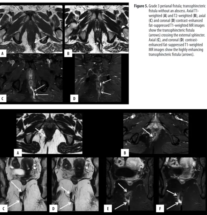 Figure 5.  Grade 3 perianal fistula; transsphincteric  fistula without an abscess. Axial  T1-weighted (A) and T2-T1-weighted (B), axial  (C) and coronal (D) contrast-enhanced  fat-suppressed T1-weighted MR images  show the transsphincteric fistula  (arrows