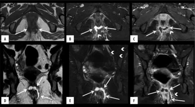 Figure 8.  Grade 4 perianal fistula; transsphincteric fistula with an abscess. Axial T1-weighted (A) and fat-suppressed T2-weighted (B), coronal  T2-weighted (D) and fat-suppressed T2-weighted (E), coronal and axial (C, F) contrast-enhanced fat-suppressed 