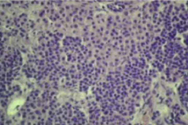 Fig. 6. Parathyroid tissue showing a combination of Chief and oxyphil cells after resection (H&amp;E stain 40  10).