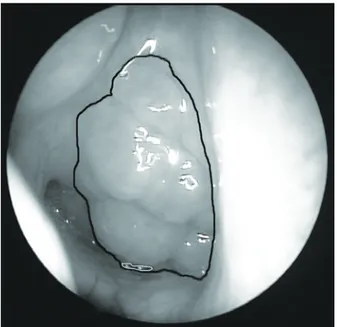 Fig. 2  The technique of measuring the ratio of choanal  opening obstructed by an adenoid mass