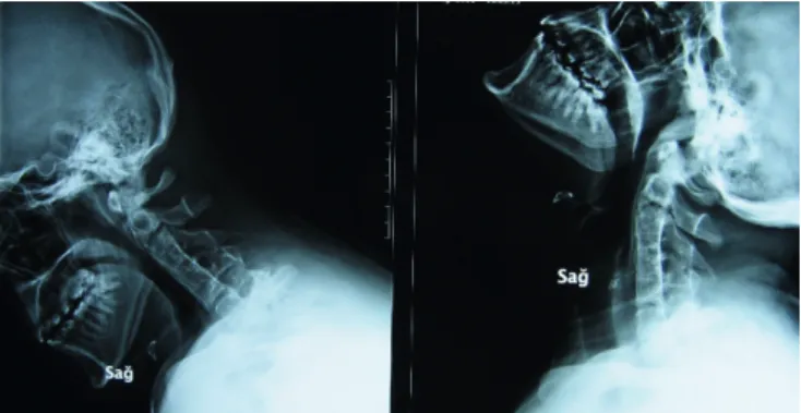 Figure 1.  Fusion of cervical vertebrae seen on lateral dynamic radiographies of  cervical vertebrae in flexion and extension.