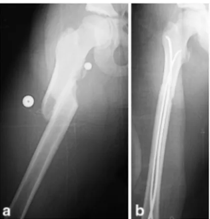 Table 1 Acceptable angulation and shortening values in paediatric femoral fractures [12] Age Varus–valgus angulation (°) Anterior–posteriorangulation (°) Shortening(mm) 0–2 years 30 30 15 2–5 years 15 20 20 6–10 years 10 15 15 11 years to maturity 5 10 10
