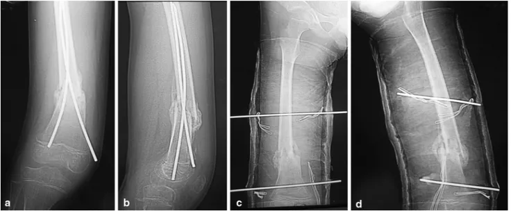 Fig. 2 a, b A 10-year-old male patient treated with titanium elastic nails. 15° valgus and 15° posterior angulation were seen in radiographs at the postoperative eighth week