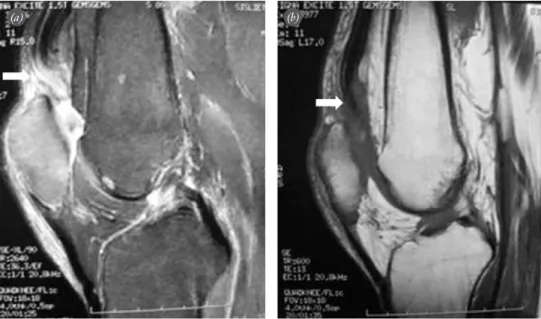 Fig. 1. (a, b) Appearance of the ruptured quadriceps tendon (arrow) in MRI sections of the second patient.