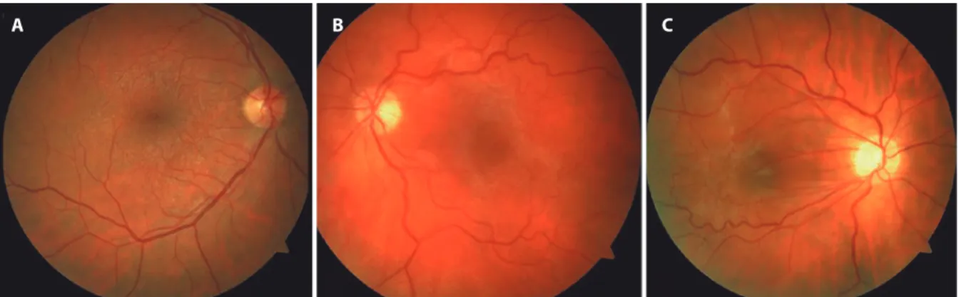 Figure 1. Fundus grading of the epiretinal membrane (ERM). A) Example of a grade 1 ERM with minimal retinal surface changes