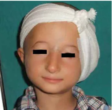 FIG. 1. Bird-like facial appearance of the child with Seckel syndrome
