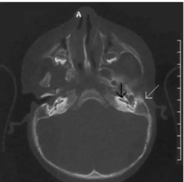 FIG. 3. Left sided congenital aural atresia in the child. Note the aural  atresia (white arrow) and normal appearing cochlea  (black arrow)
