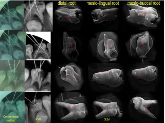 graphic	  methods	  in	  measurement	   of	  the	  root	  canal	  working	  length	  of	   maxillary	  incisor	  or	  canine	  teeth.	  
