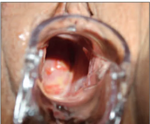 FIGURE 1: Two ulcers of 1 cm and 0,5 cm on the vaginal cuff.