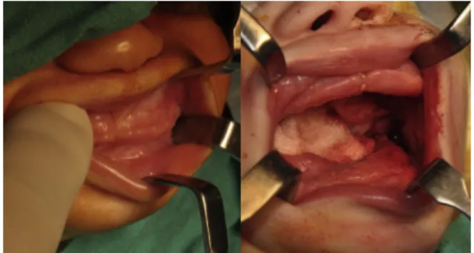 Fig. 2. Zygomaticomaxillary and mandibular bony fusion marked by arrows.