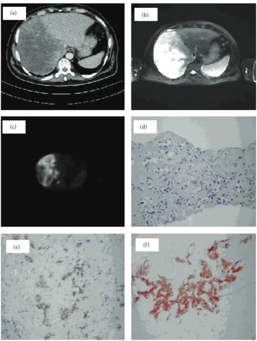 Figure 1: (a) CT scan, 20×14 cm size hypoattenuating multinodular tumor mainly filling the right lobe of the liver with irregular boundaries.