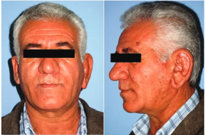 Figure 1. left unilateral macrotia.