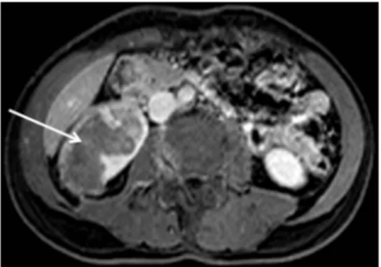 Figure 1 Large renal tumour at the MRI of the right kidney (arrow).