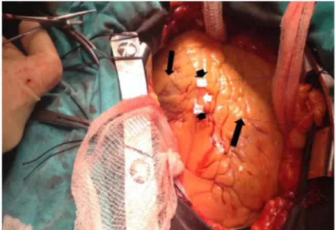 Figure 3 Operative view of the off-pump coronary artery bypass grafting with stay sutures (black arrows) and pledgets (black arrow heads) providing a bloodless and stable zone for the anastomosis of the target vessel (white arrow head).