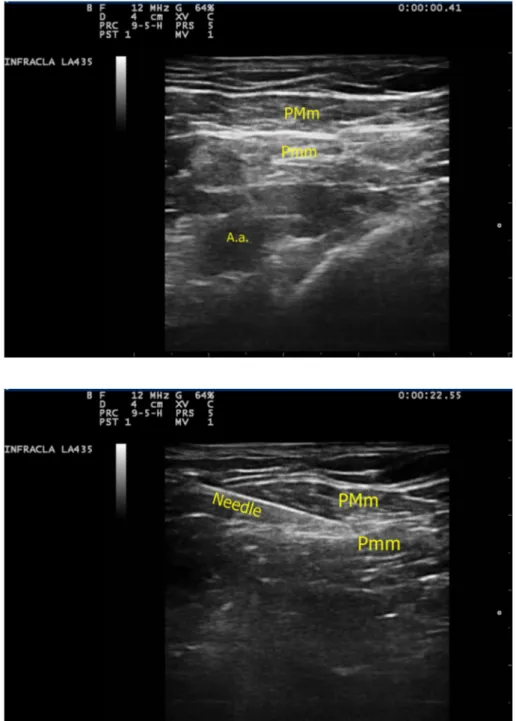 Fig. 2 Ultrasound image of needle direction between the muscles