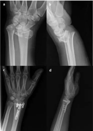 Fig. 1. (a, b) Preoperative and (c, d) 14-month postoperative anteroposterior and lateral views of the left wrist of a 39-year-old man treated with a volar locking rim plate.