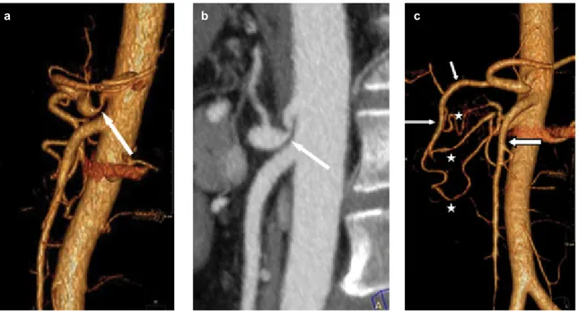 FIG. 1. a-c. Sagittal 3D VR image (a), Sagittal MIP image (b), CT angiogram demonstrating acute angulation and narrowing of the proximal celiac  artery
