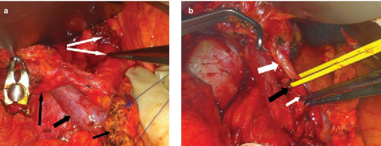 FIG. 2. a,b. Intraoperative images before (a) and after (b) release of the MAL. After clamping the GDA, the GDA and CHA were seen to lose their  luminal tension (a)