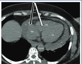 Figure 1. Computed tomography image showing pericardial  effusion and catheters placed in right ventricle (white arrow)  and pericardial cavity (black arow)