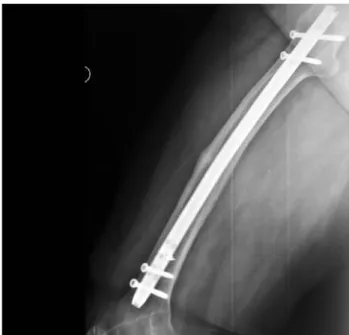Fig. 3. This impending fracture localized at the right femur diaphysis was also treated with interlocked intramedullary nailing.