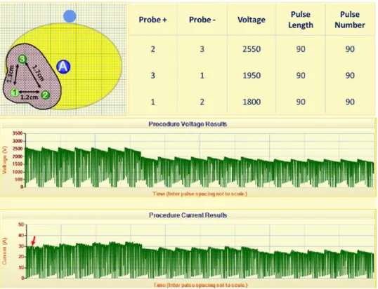 Figure 5.  (a) The electrical field [V/cm] and (b) electrical conductivity distribution [S/m] of an IRE treatment in  prostate with solid monopolar electrodes