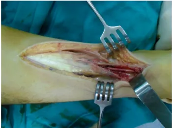 Fig. 1 The gap between stumps was evaluated after debridement of the fibrous tissues in neutral ankle position