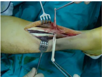 Fig. 3 View of the reconstruction before the closure of the tendon sheath